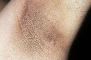 Acanthosis nigricans pod pachą