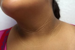 Acanthosis nigricans na szyi